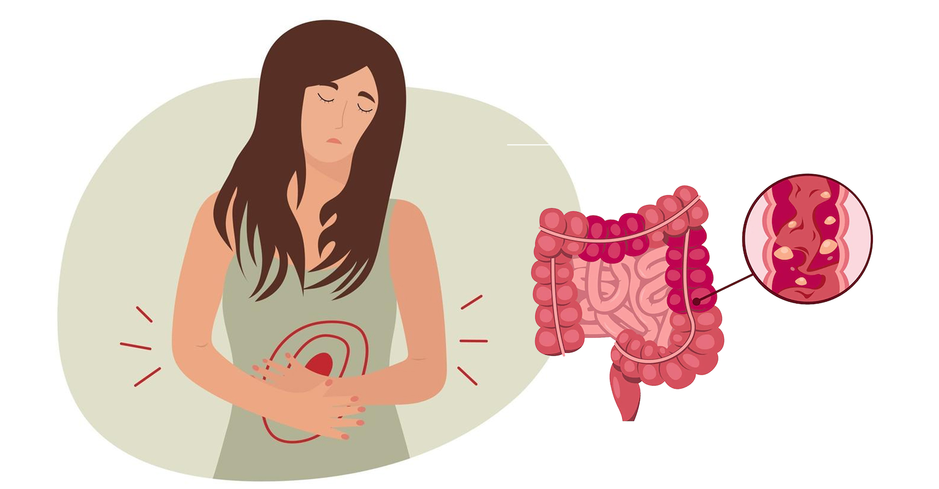 IBD Treatment in Hyderabad